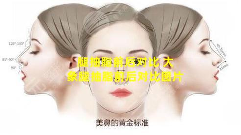 腿抽脂前后对比 大象腿抽脂前后对比图片